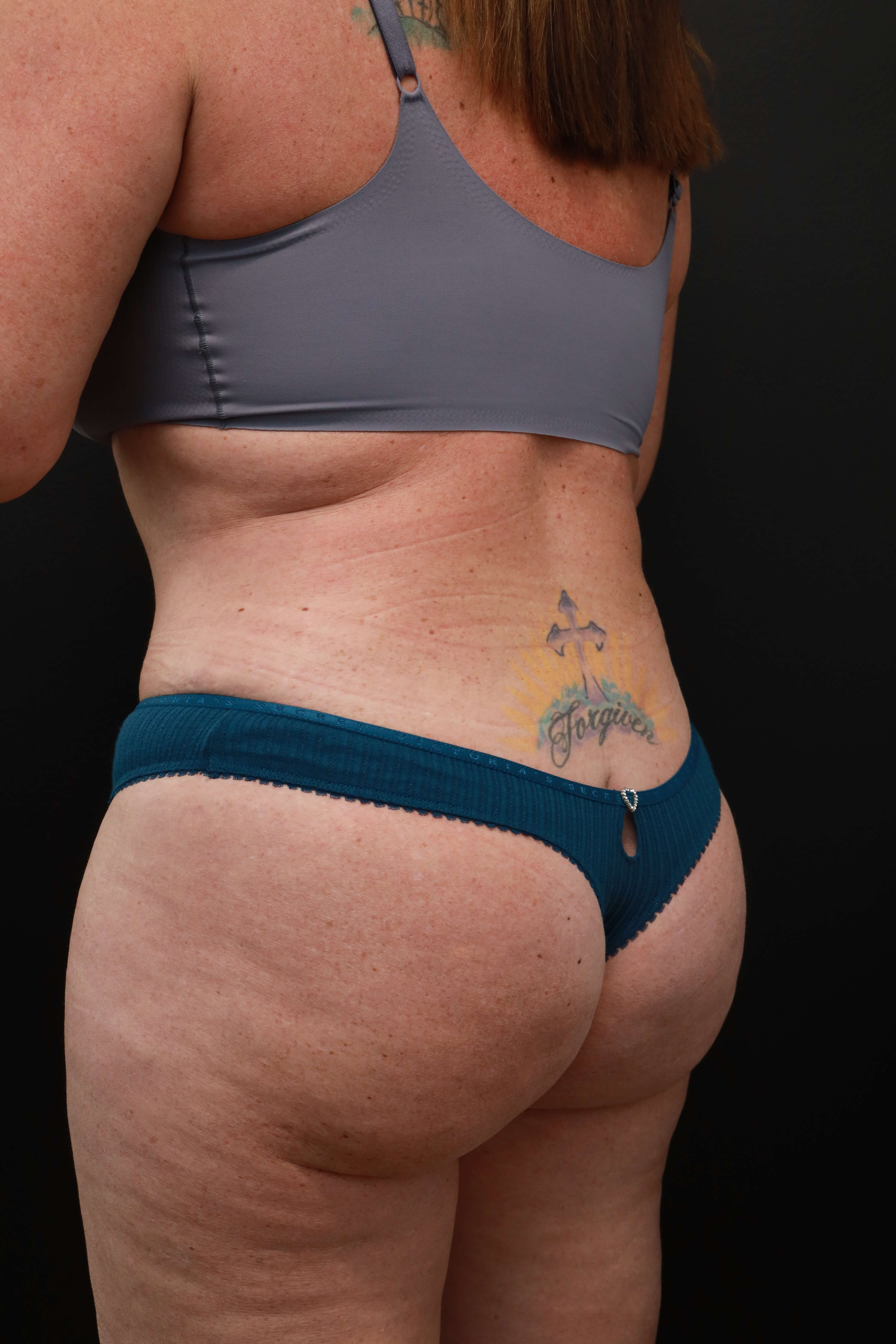 Left Back Oblique After