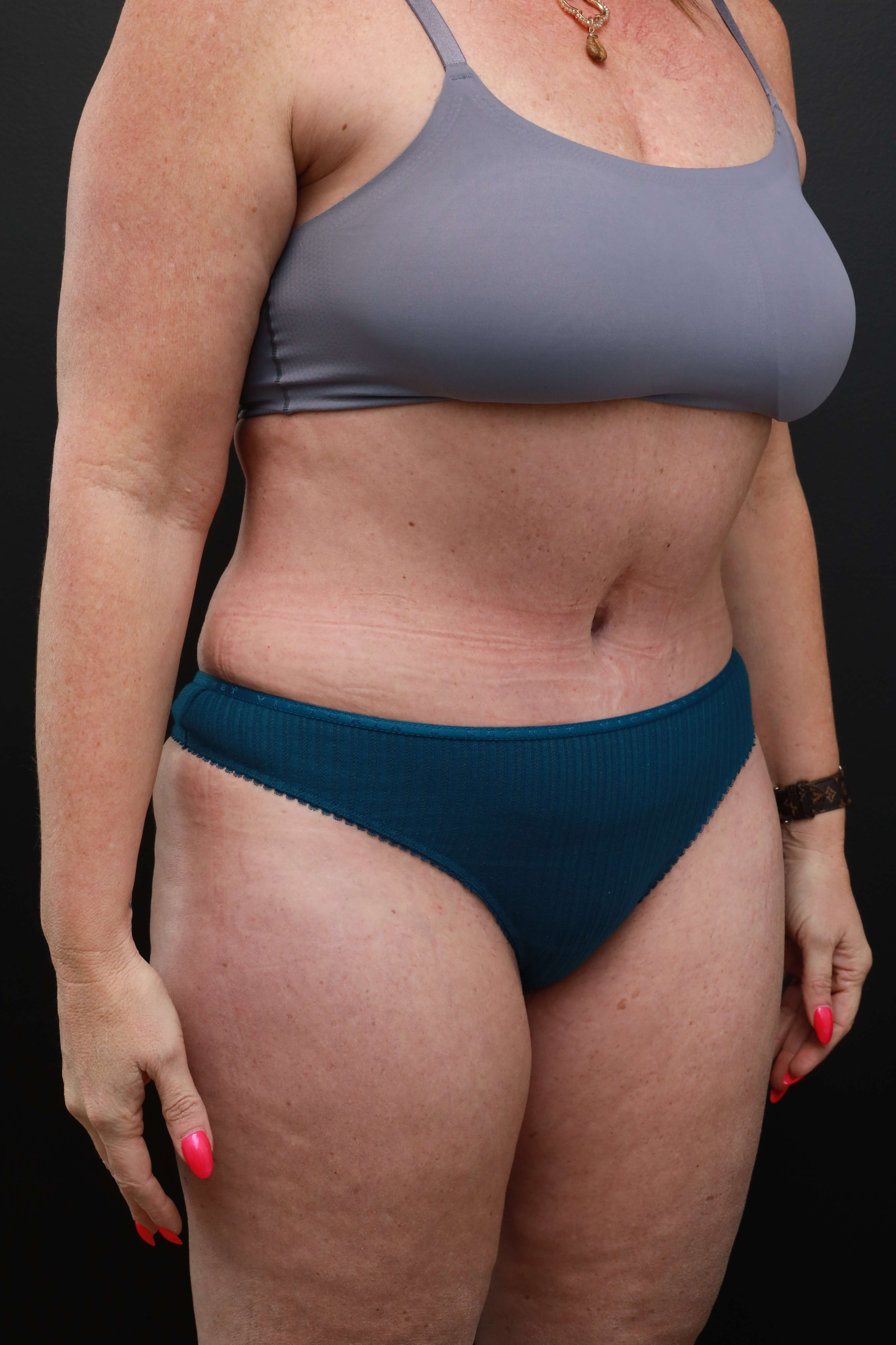 Right Oblique After