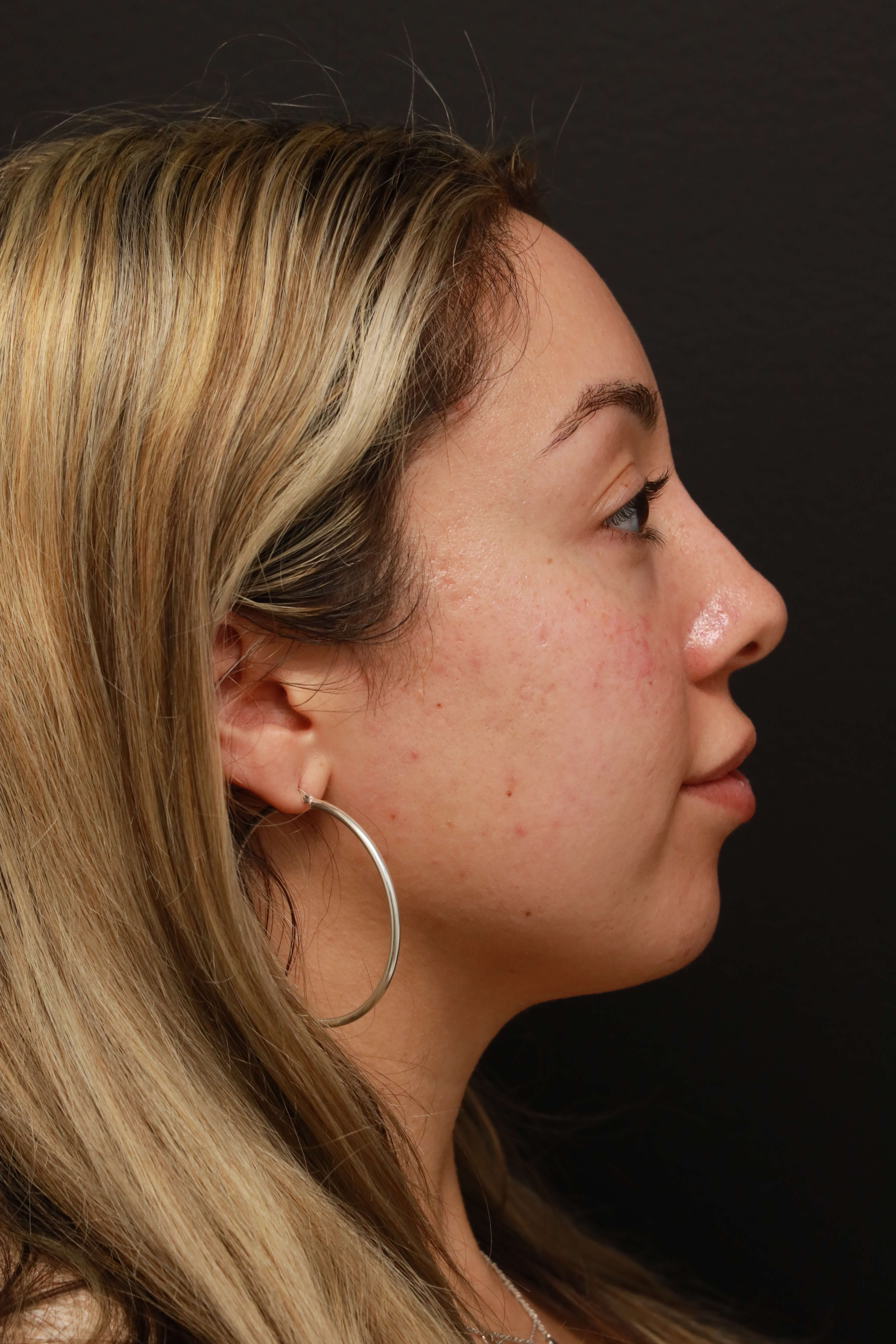 Right Lateral Before