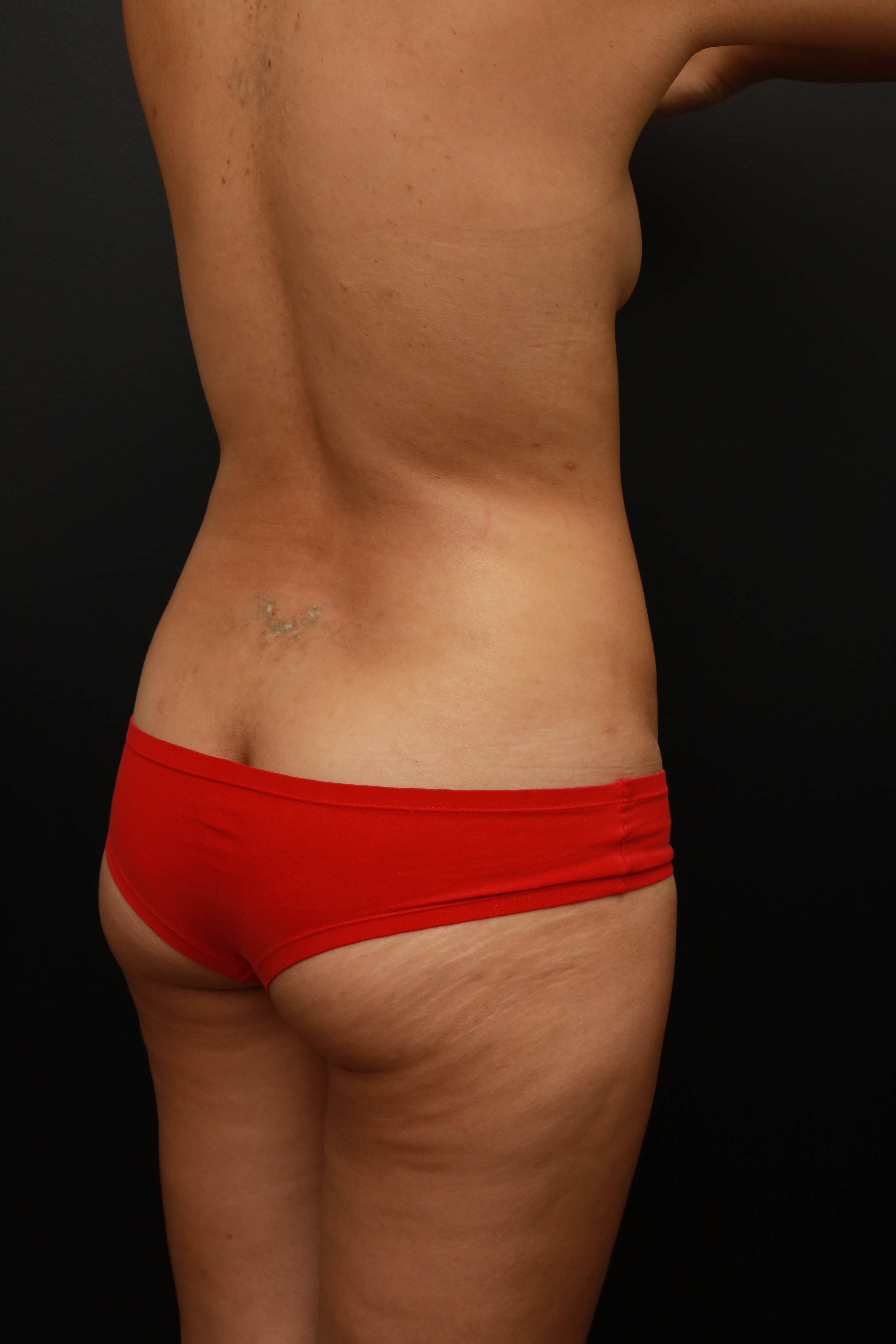 Right Oblique Posterior Before