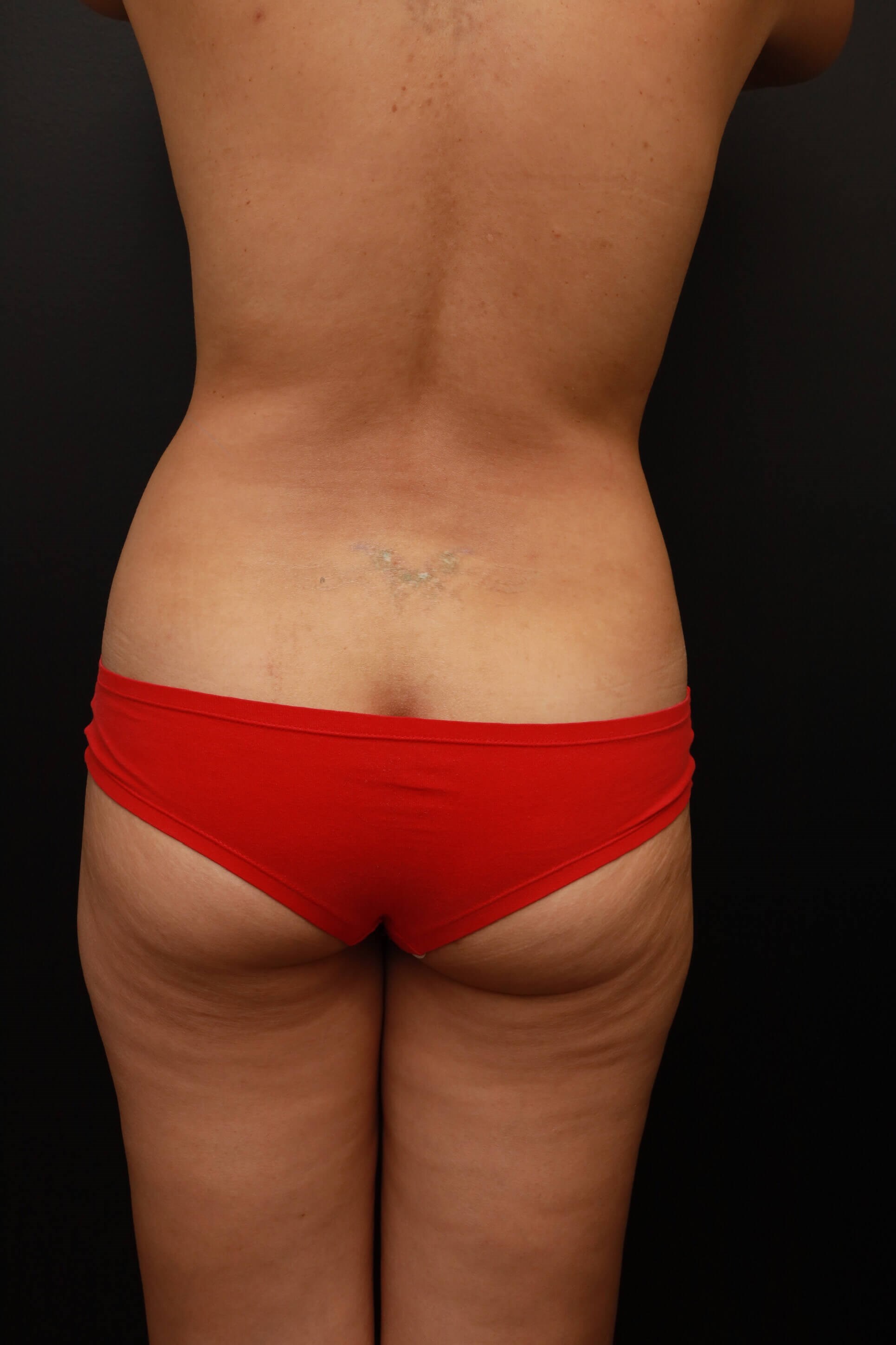 Posterior Before