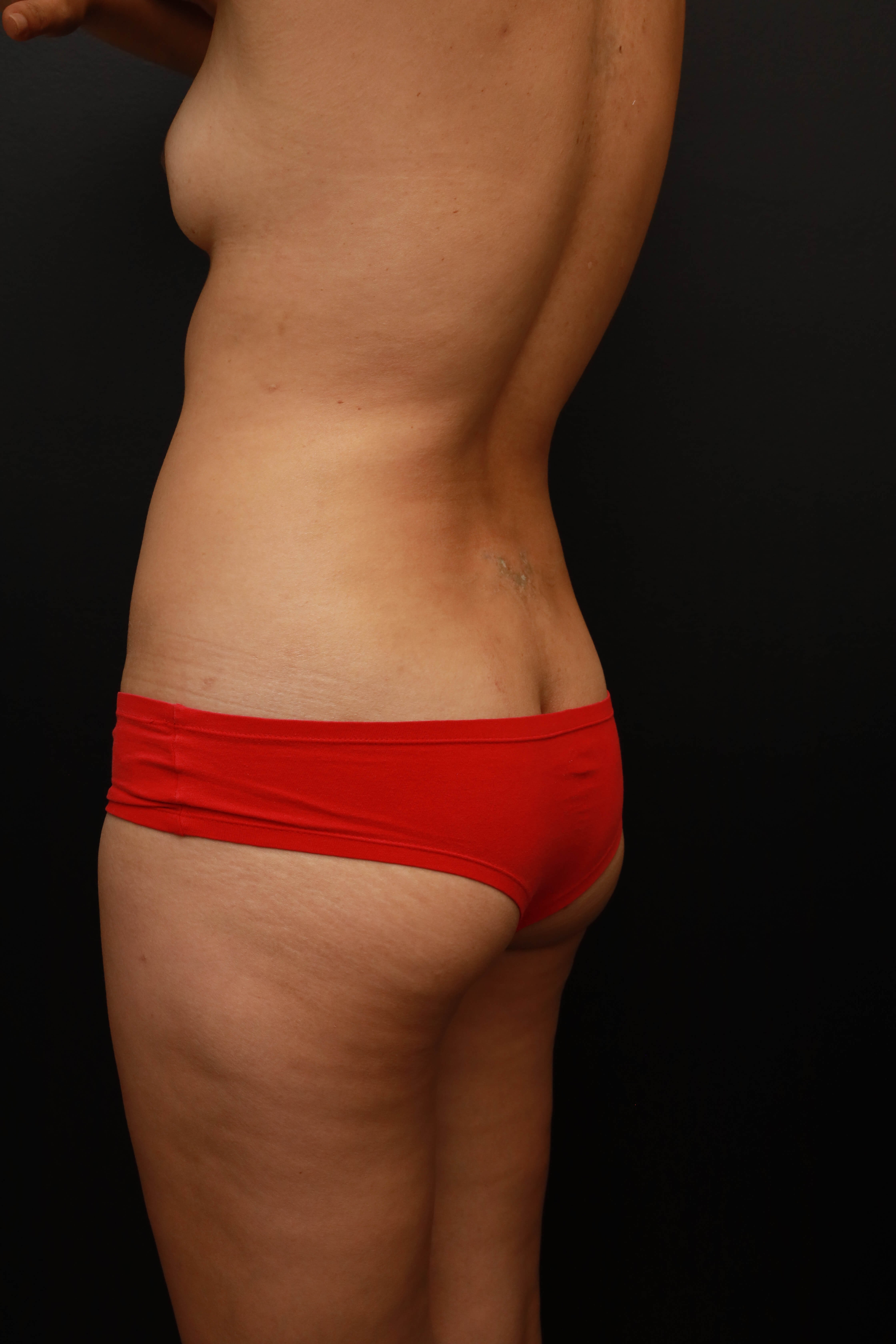 Left Oblique Posterior Before