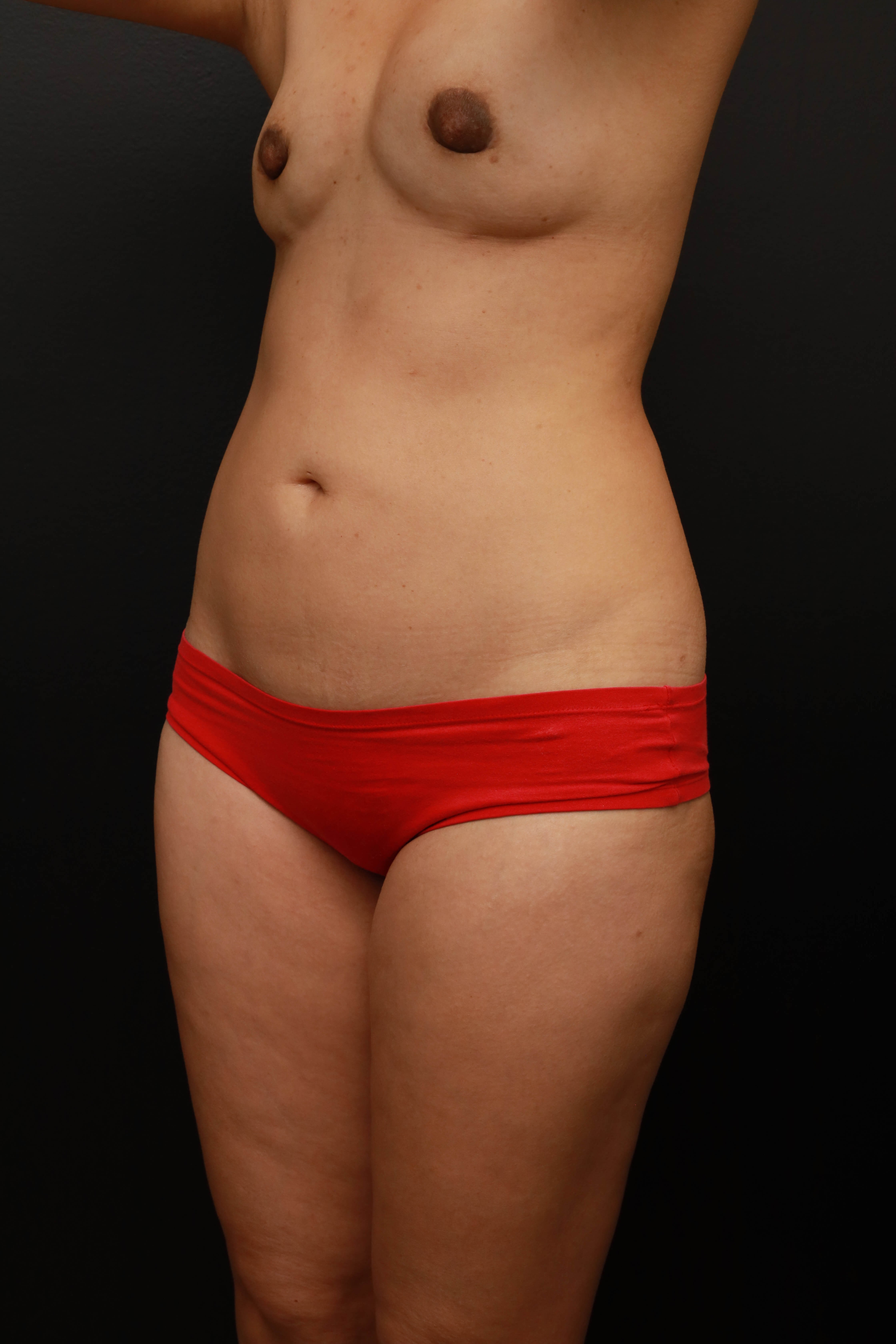Left Oblique Before