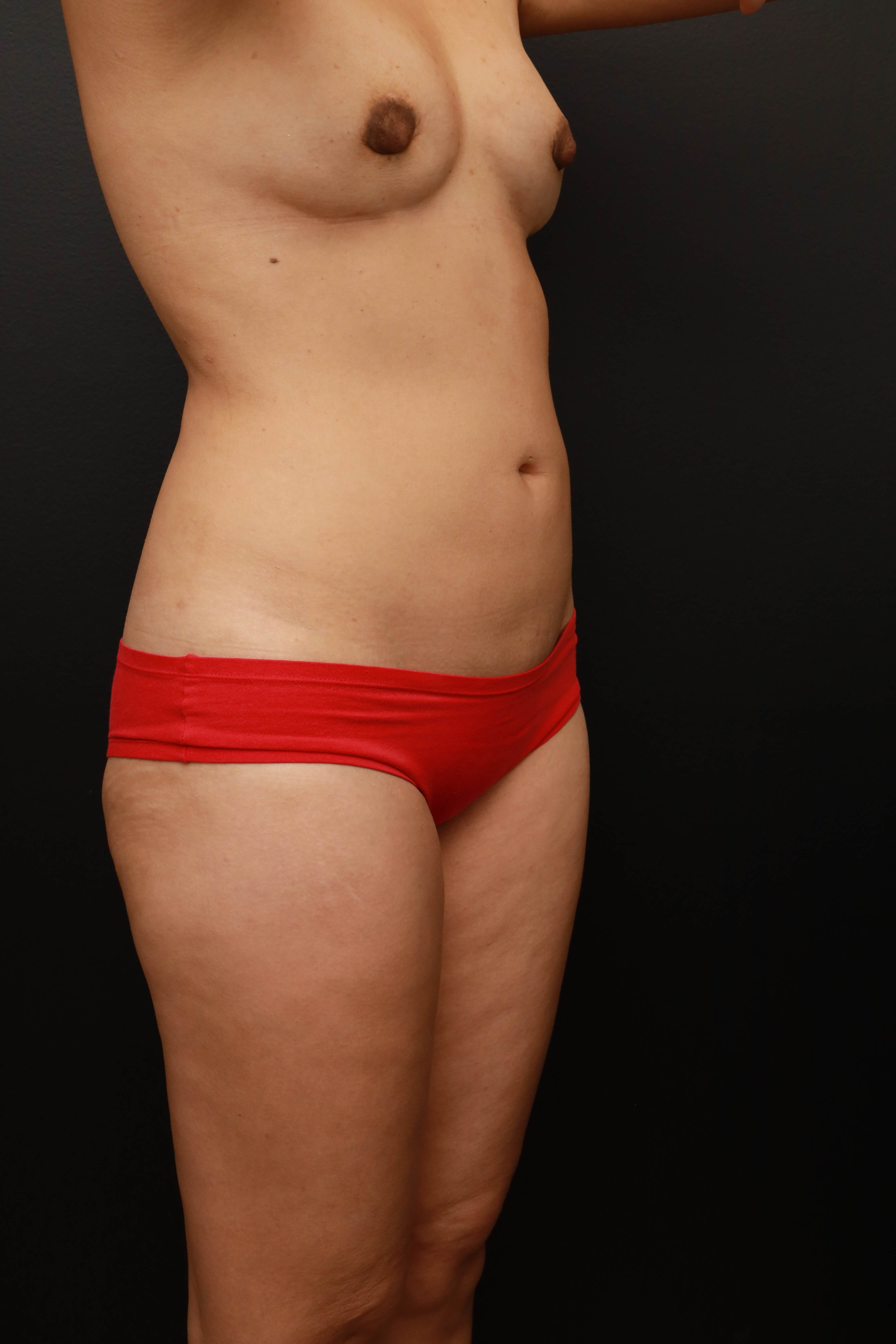 Right Oblique Before