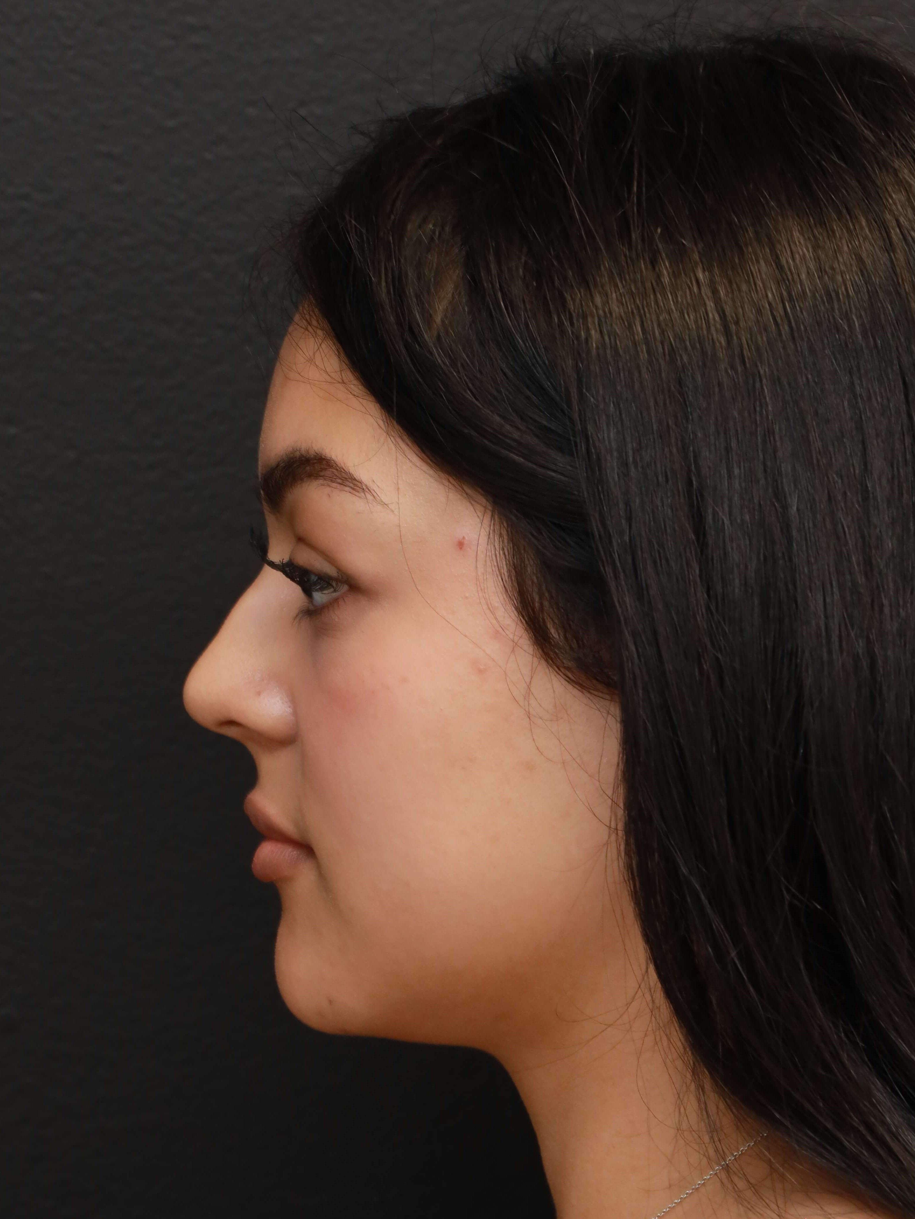 Left Lateral Before