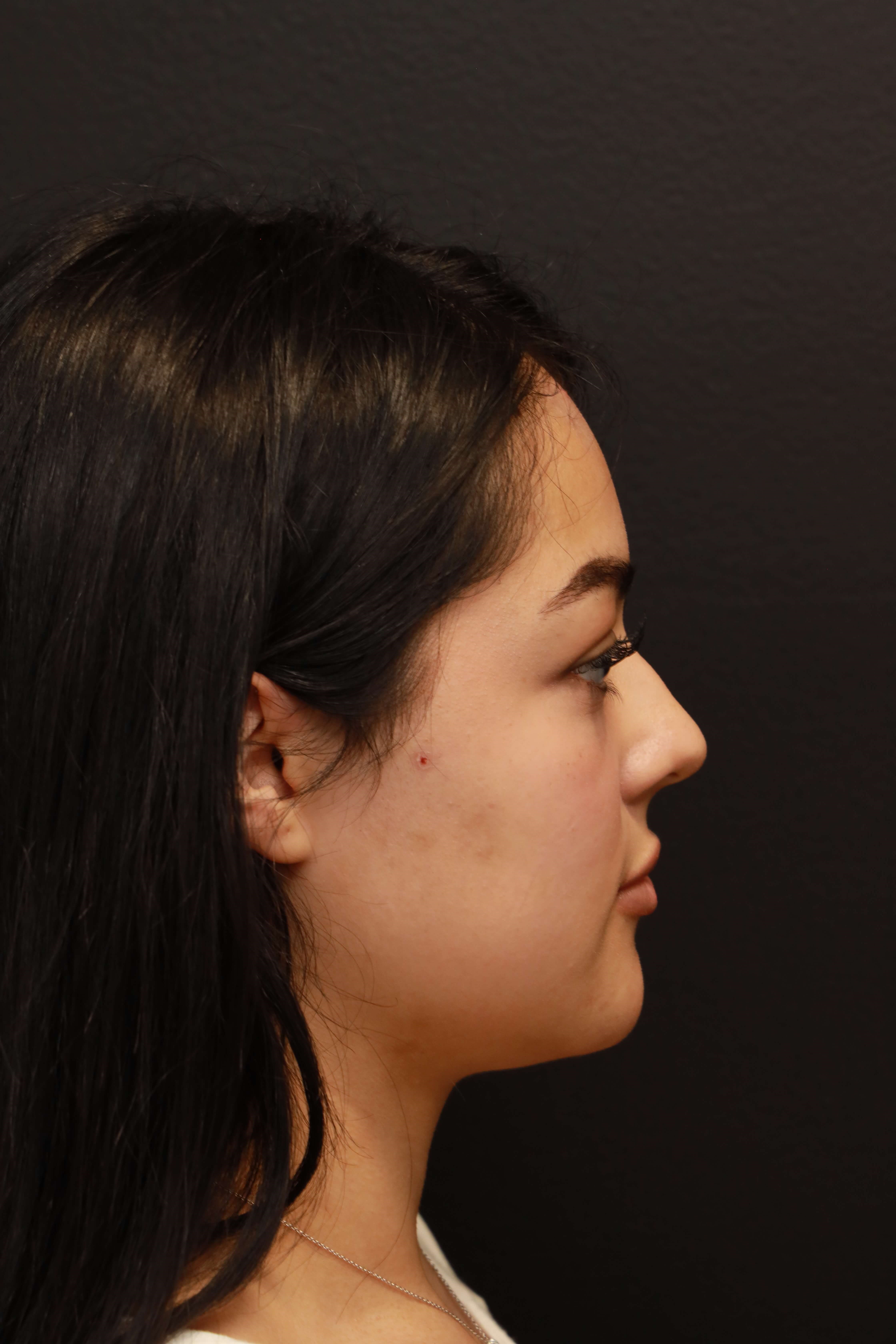 Right Lateral Before