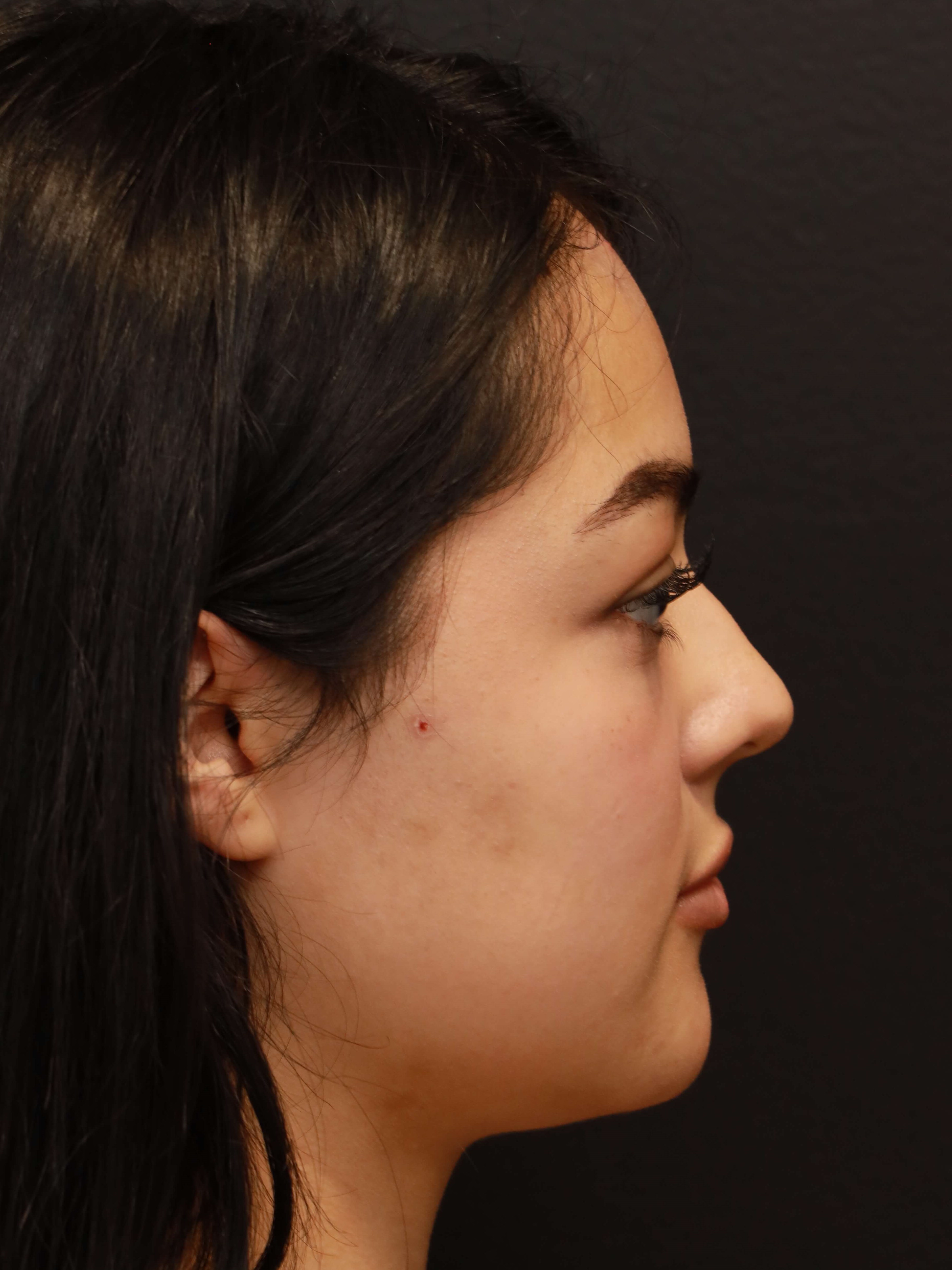 Right Lateral Before