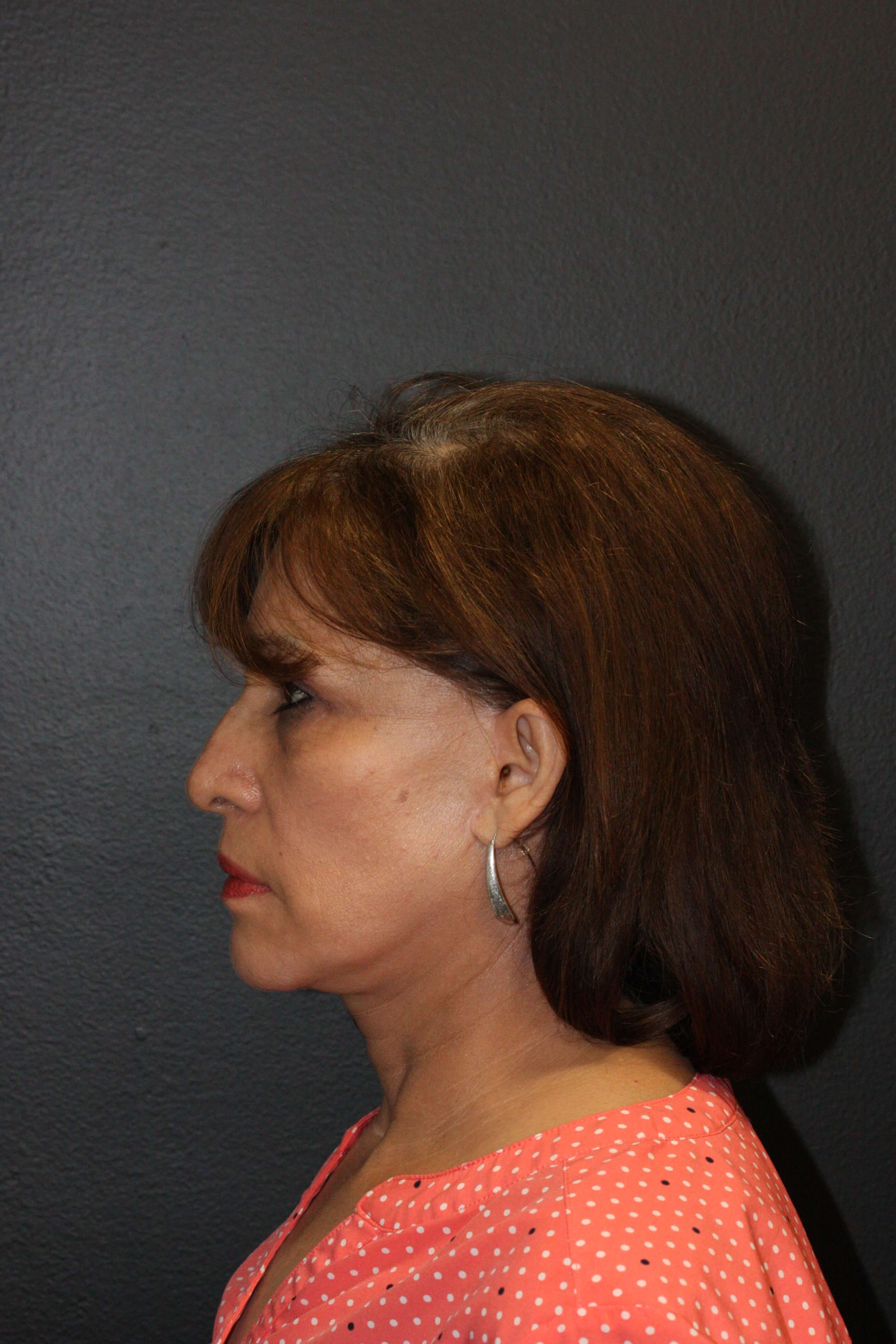 Left Lateral After