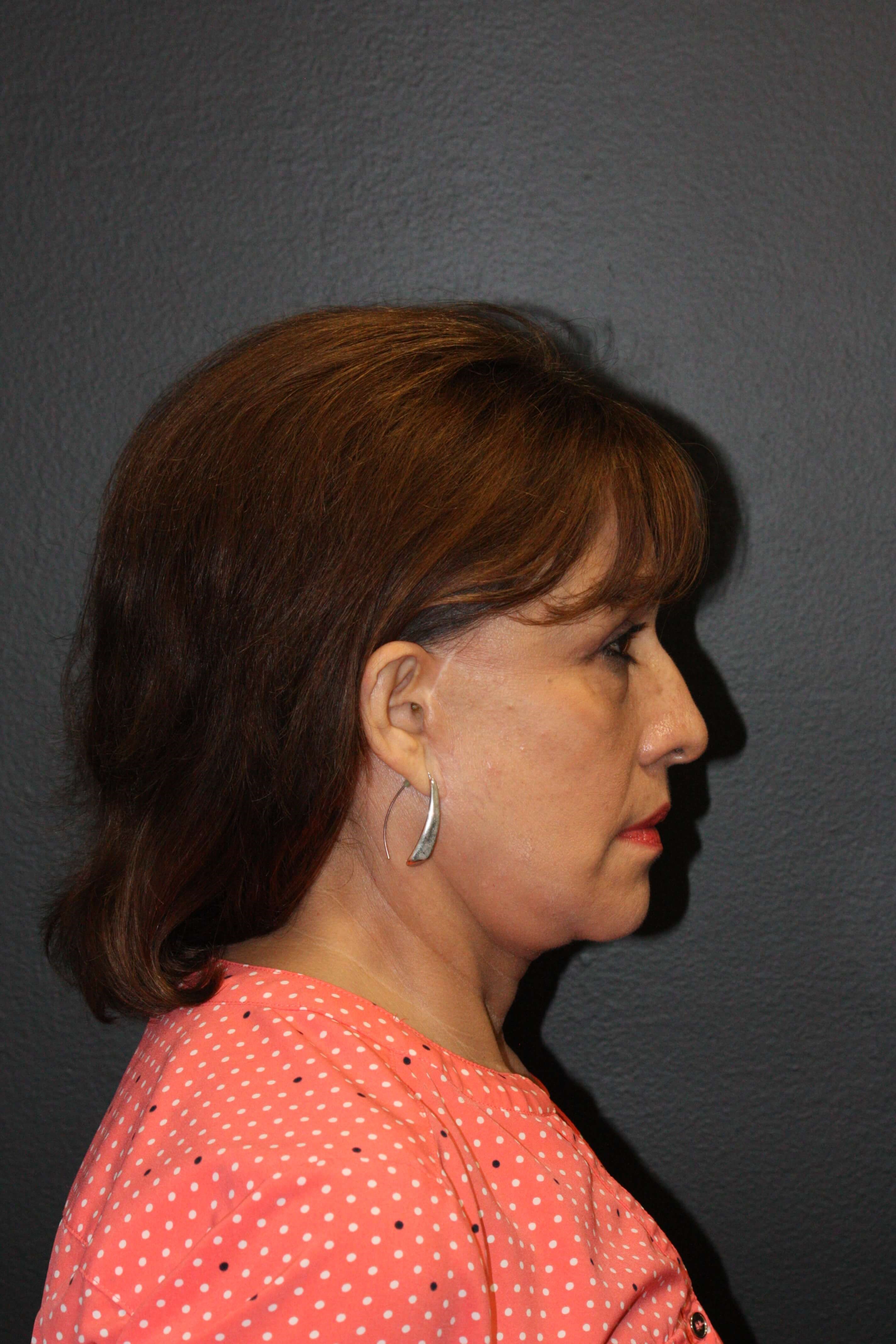 Right Lateral After