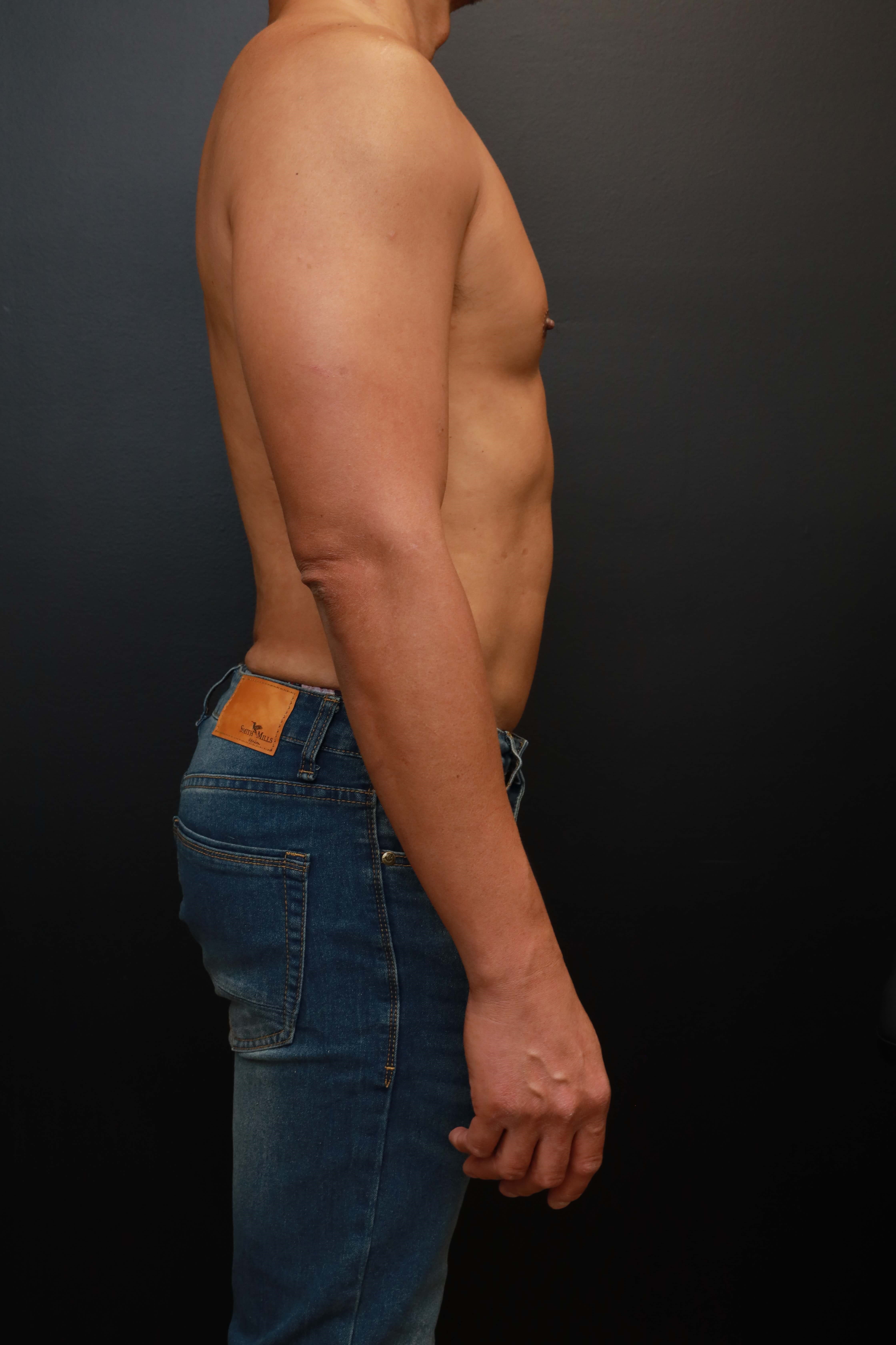 Right Lateral After