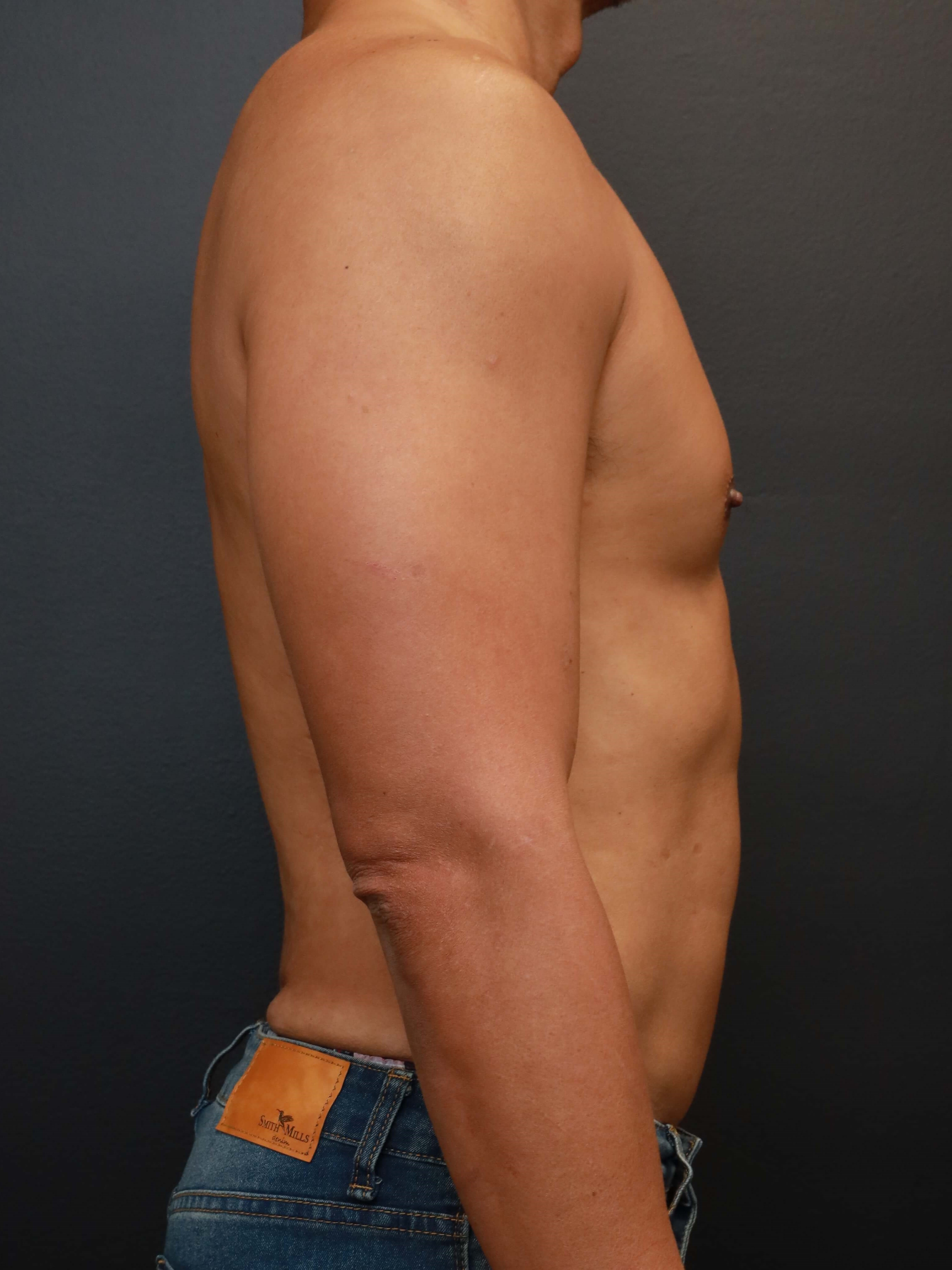 Right Lateral After