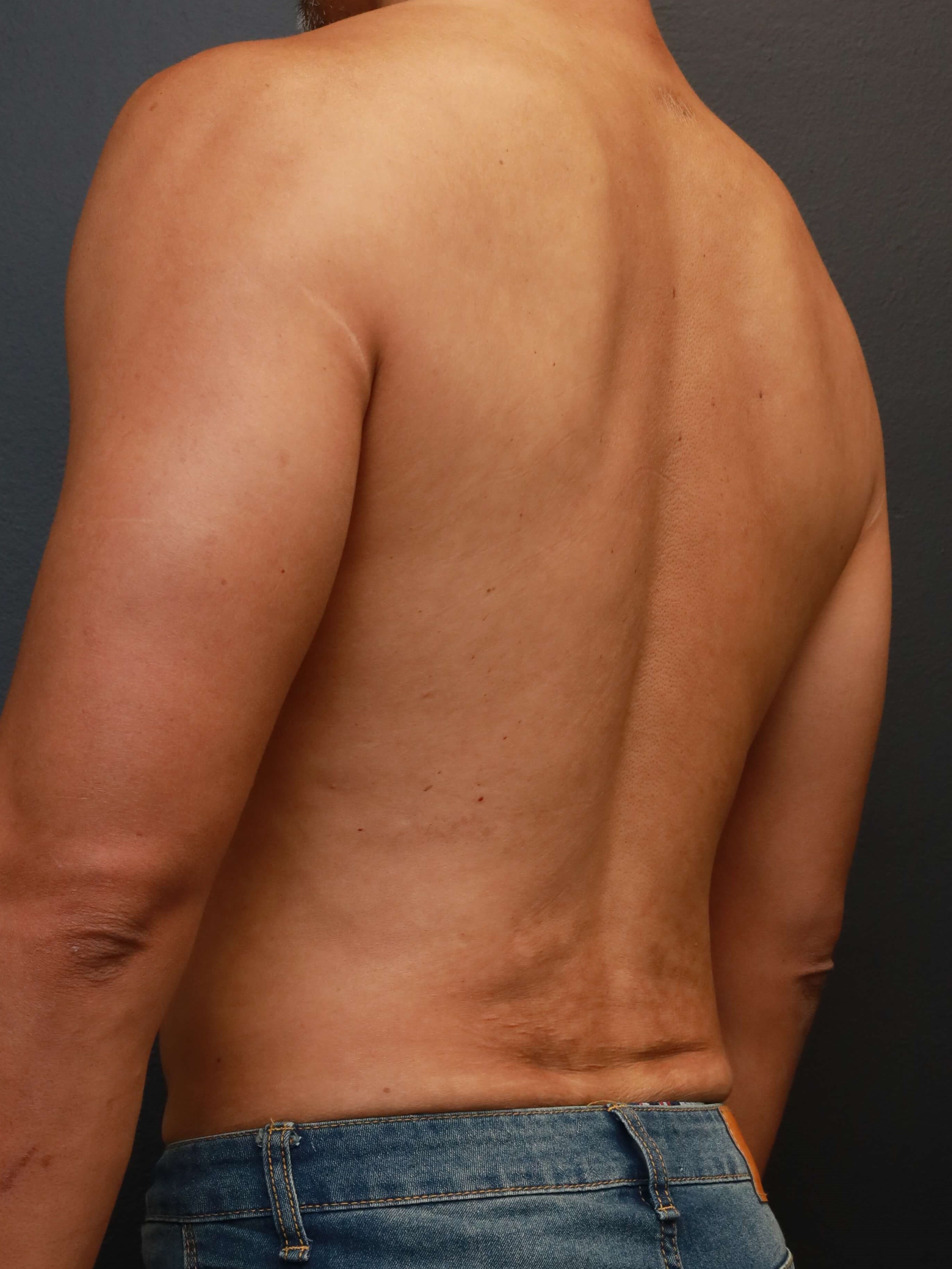 Left Back Oblique After