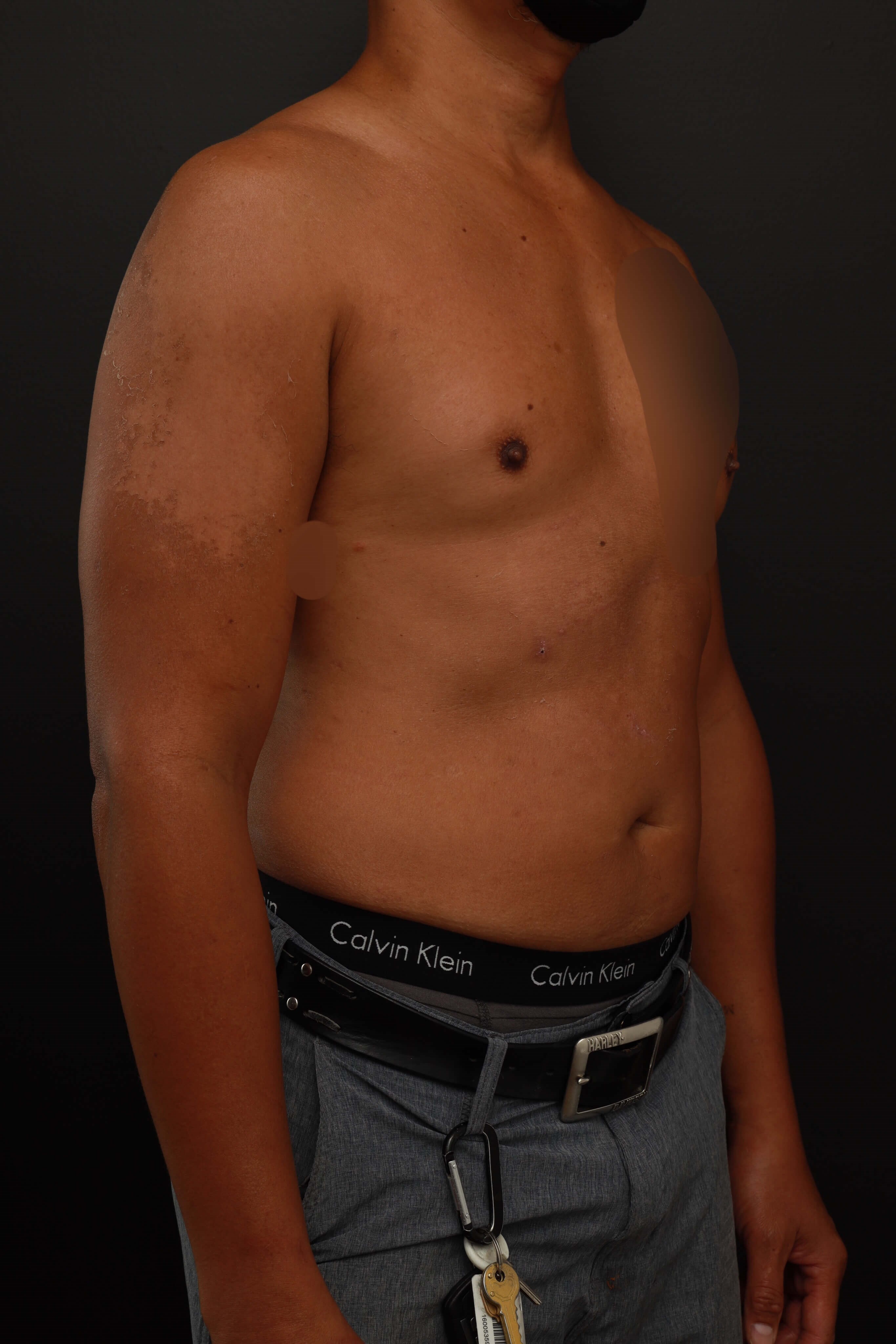 Right Oblique Before