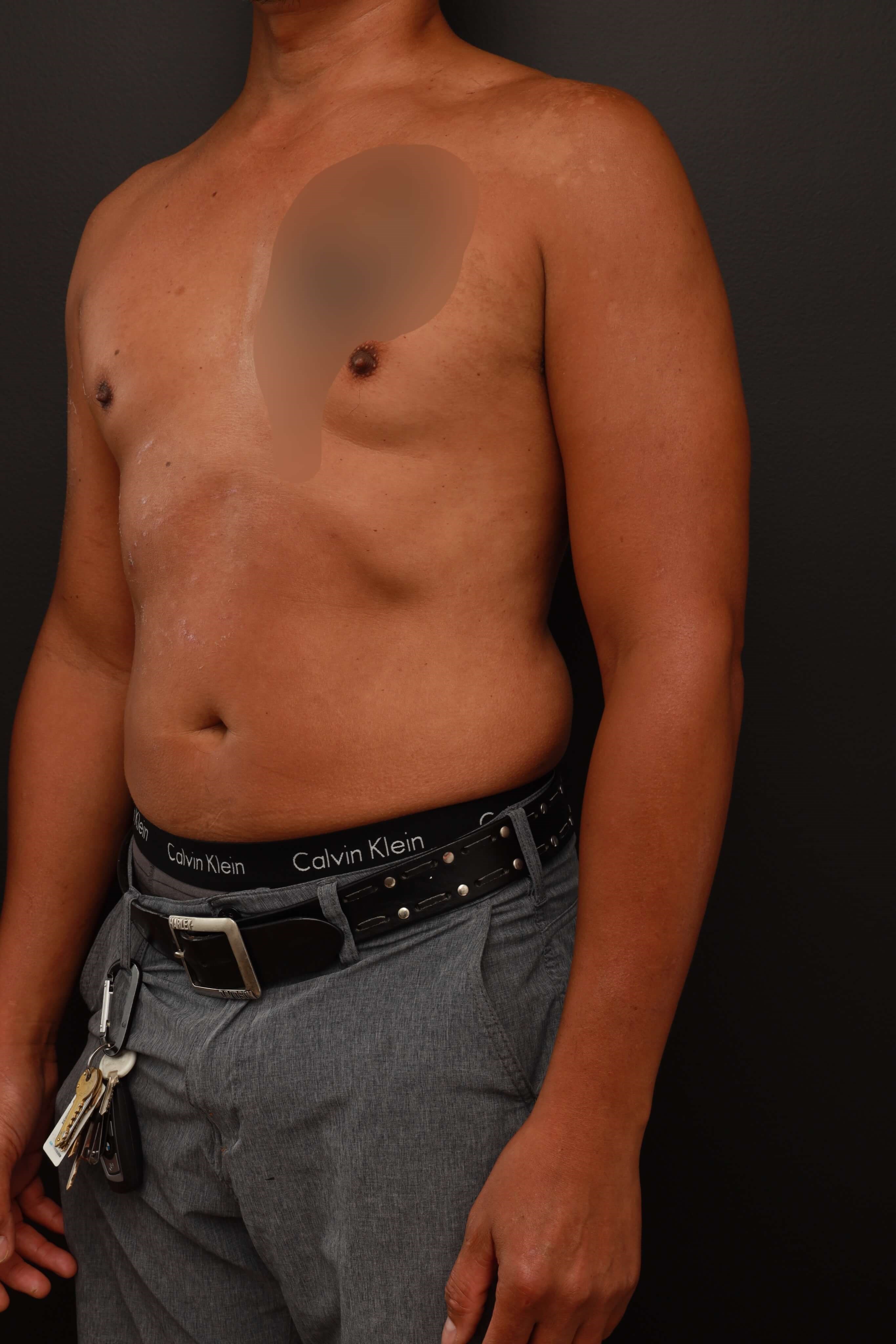 Left Oblique Before