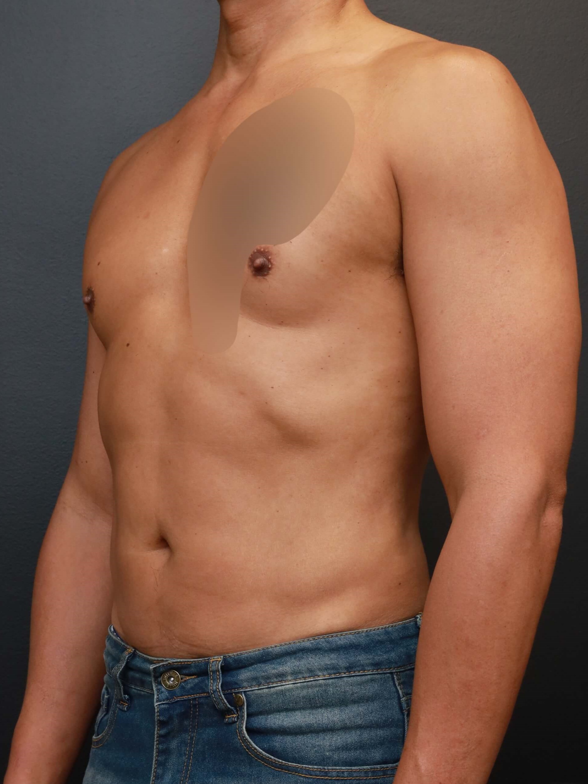 Left Oblique After