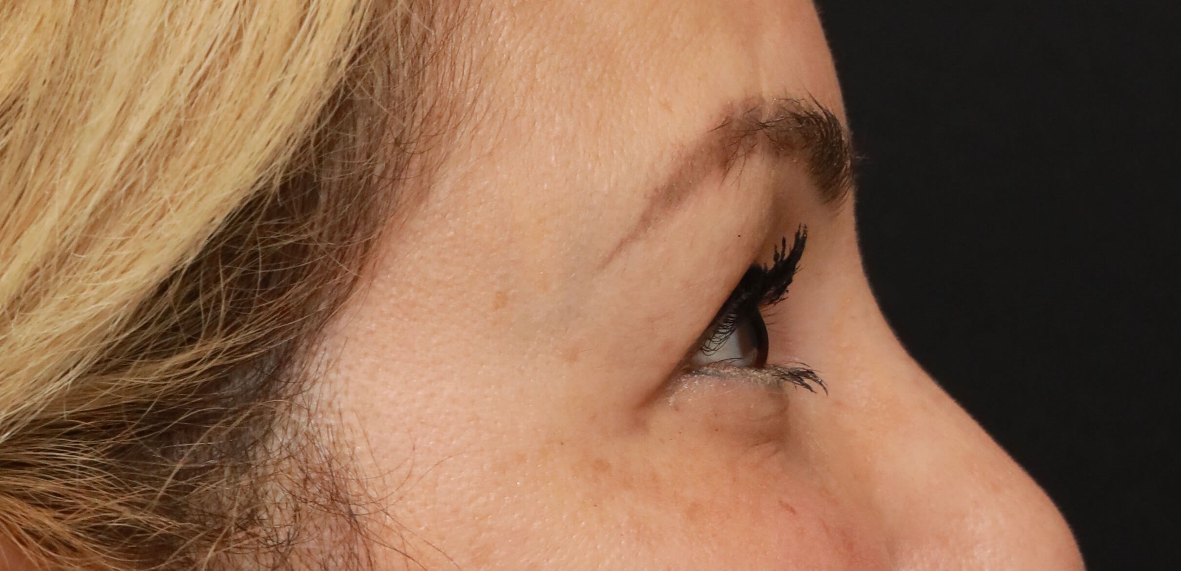 Right Lateral Before