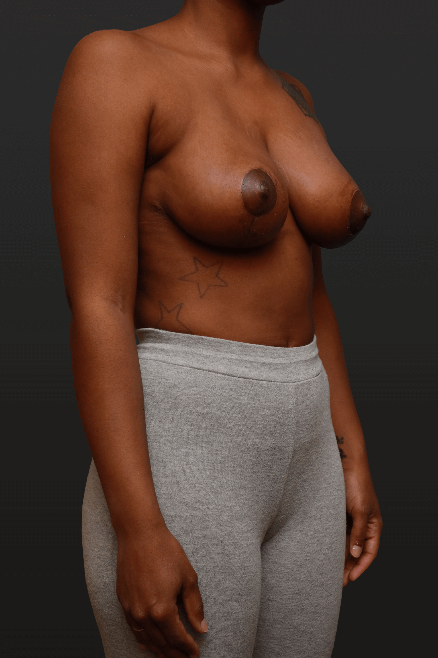 Right Oblique After