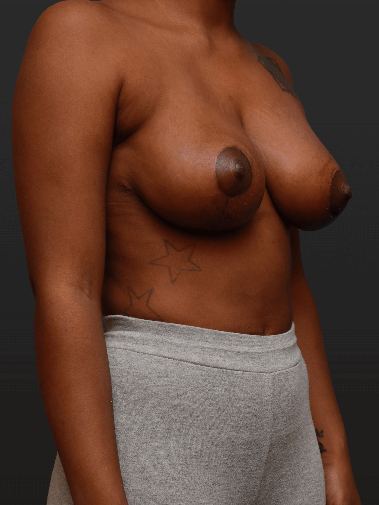 Right Oblique After