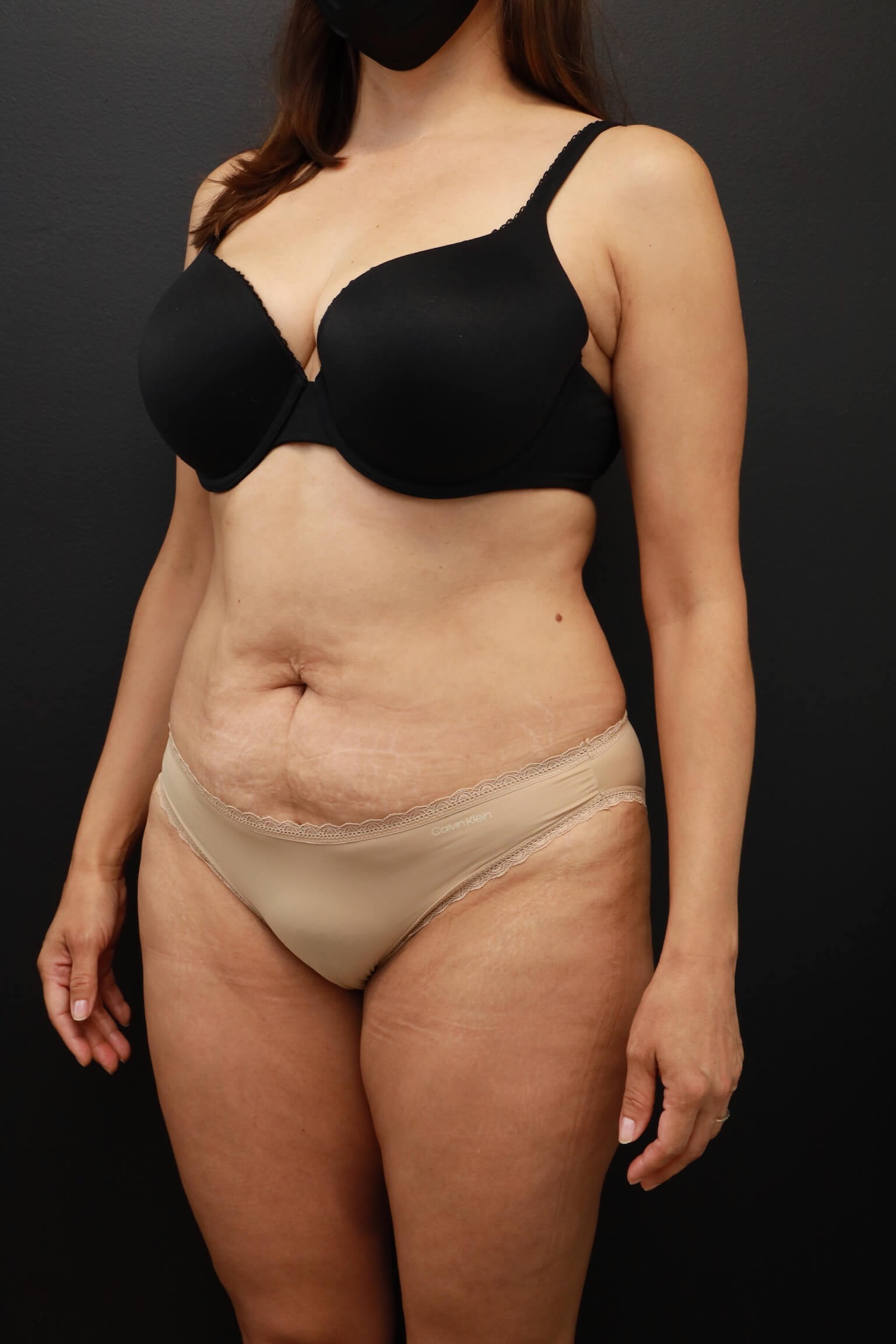 Left Oblique Before