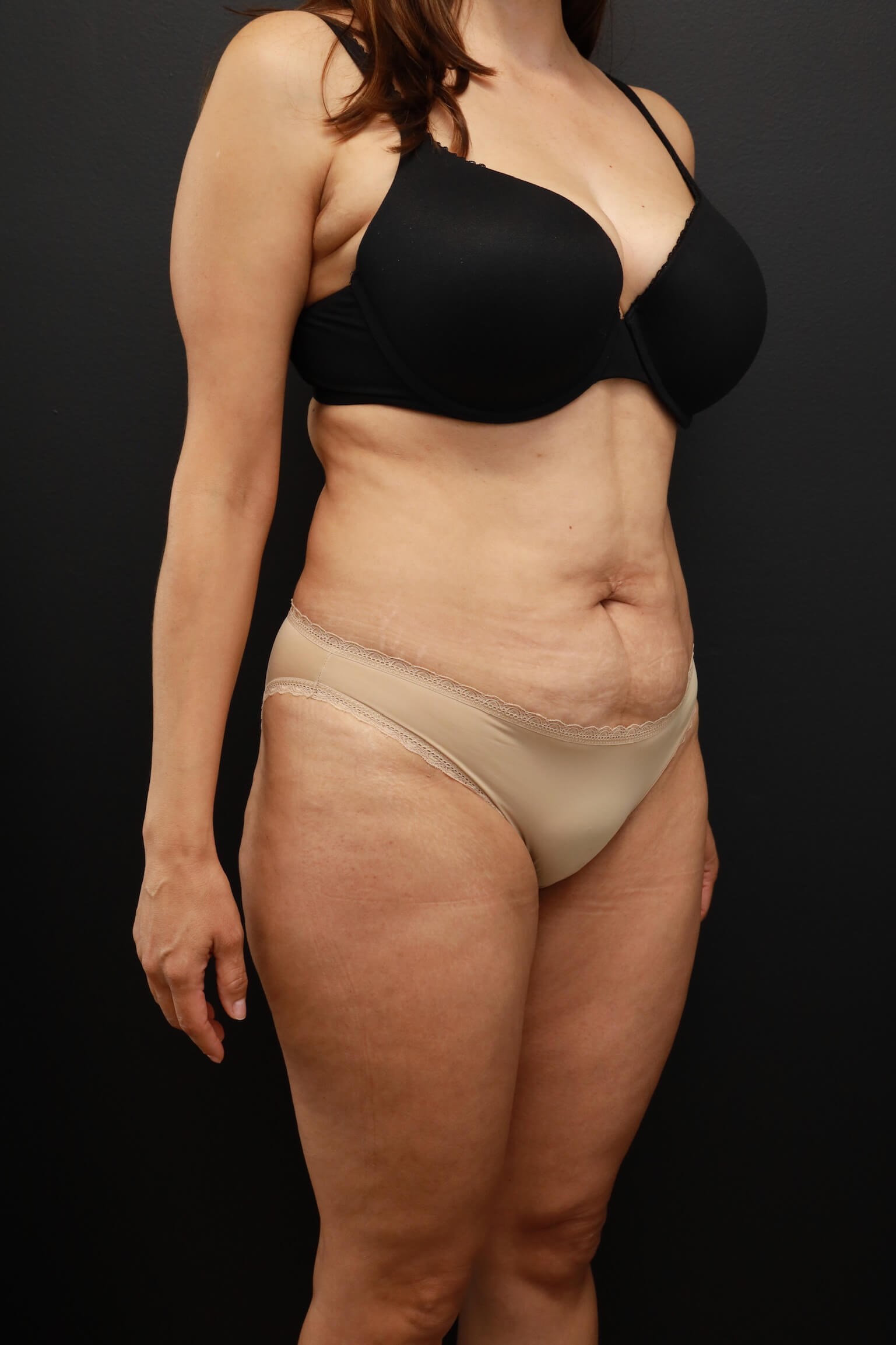 Right Oblique Before