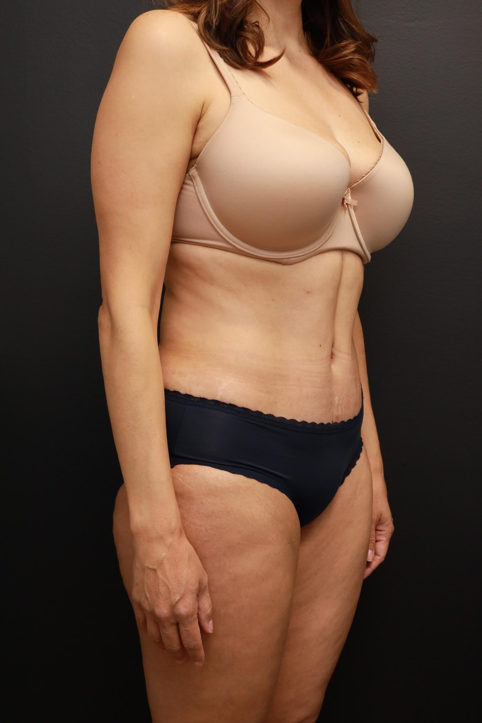 Right Oblique After