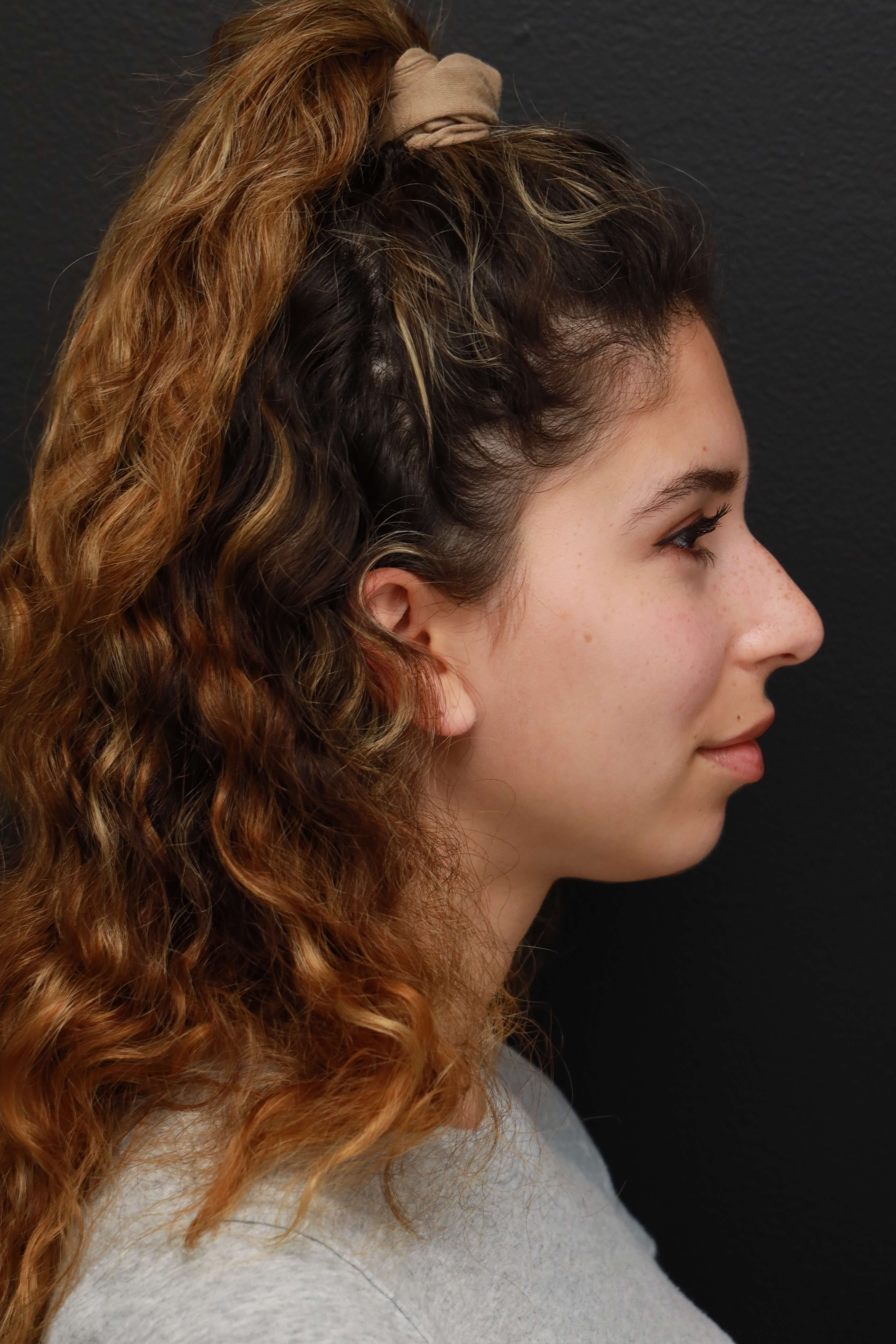Right Lateral Before
