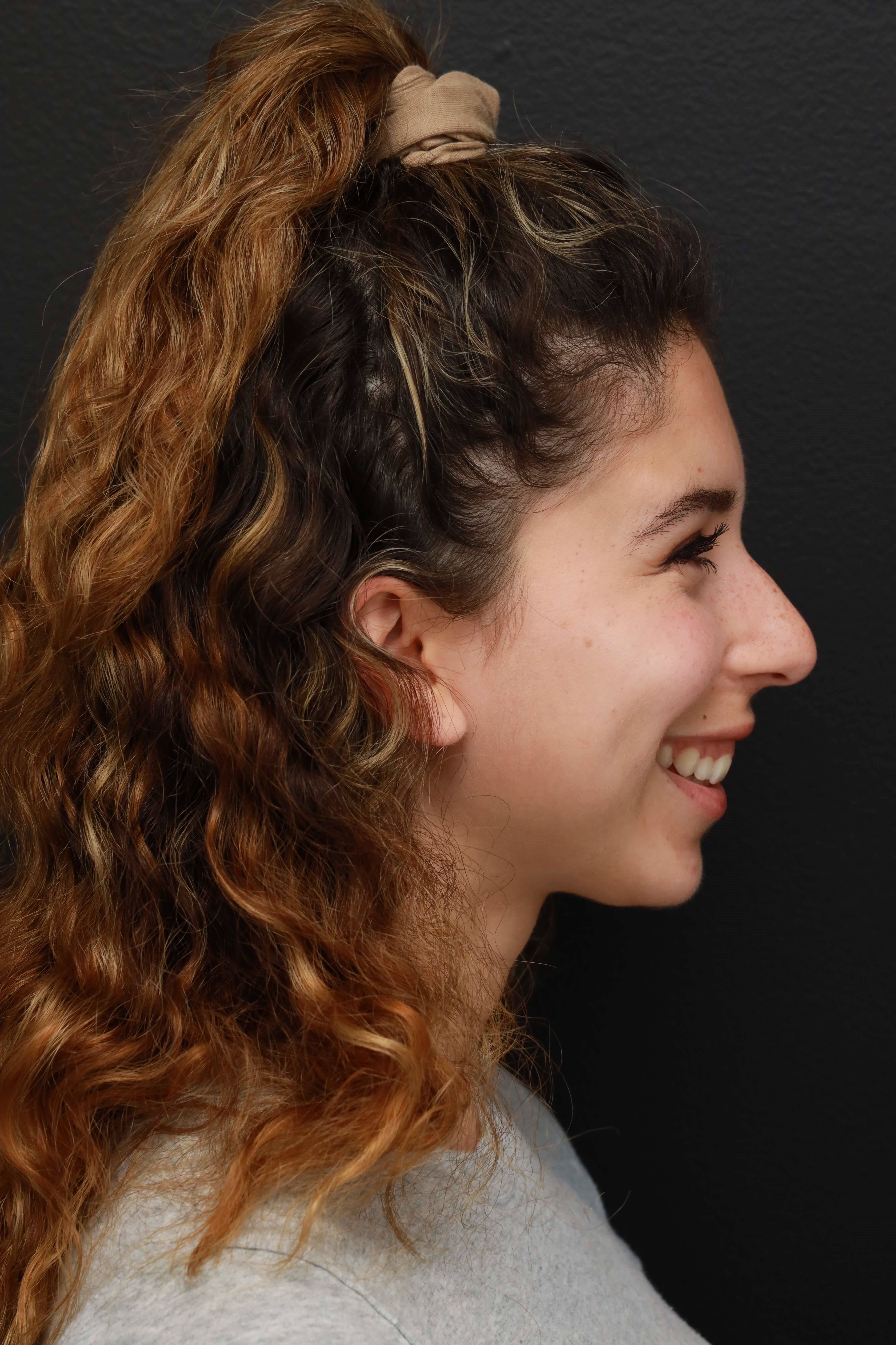 Right Lateral Smiling Before
