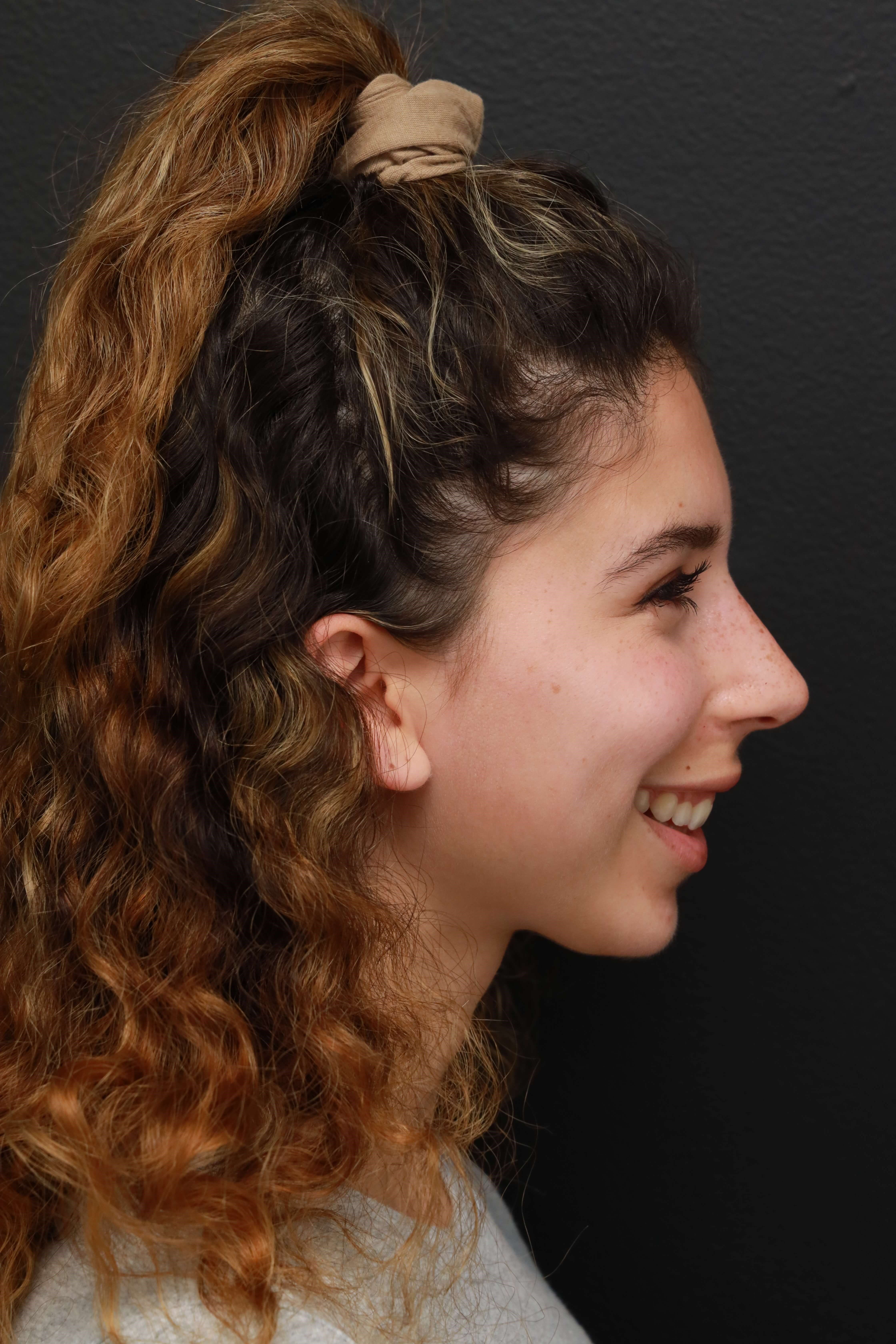 Right Lateral Smiling After