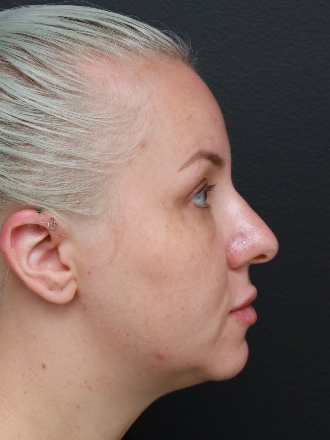 Right Lateral After