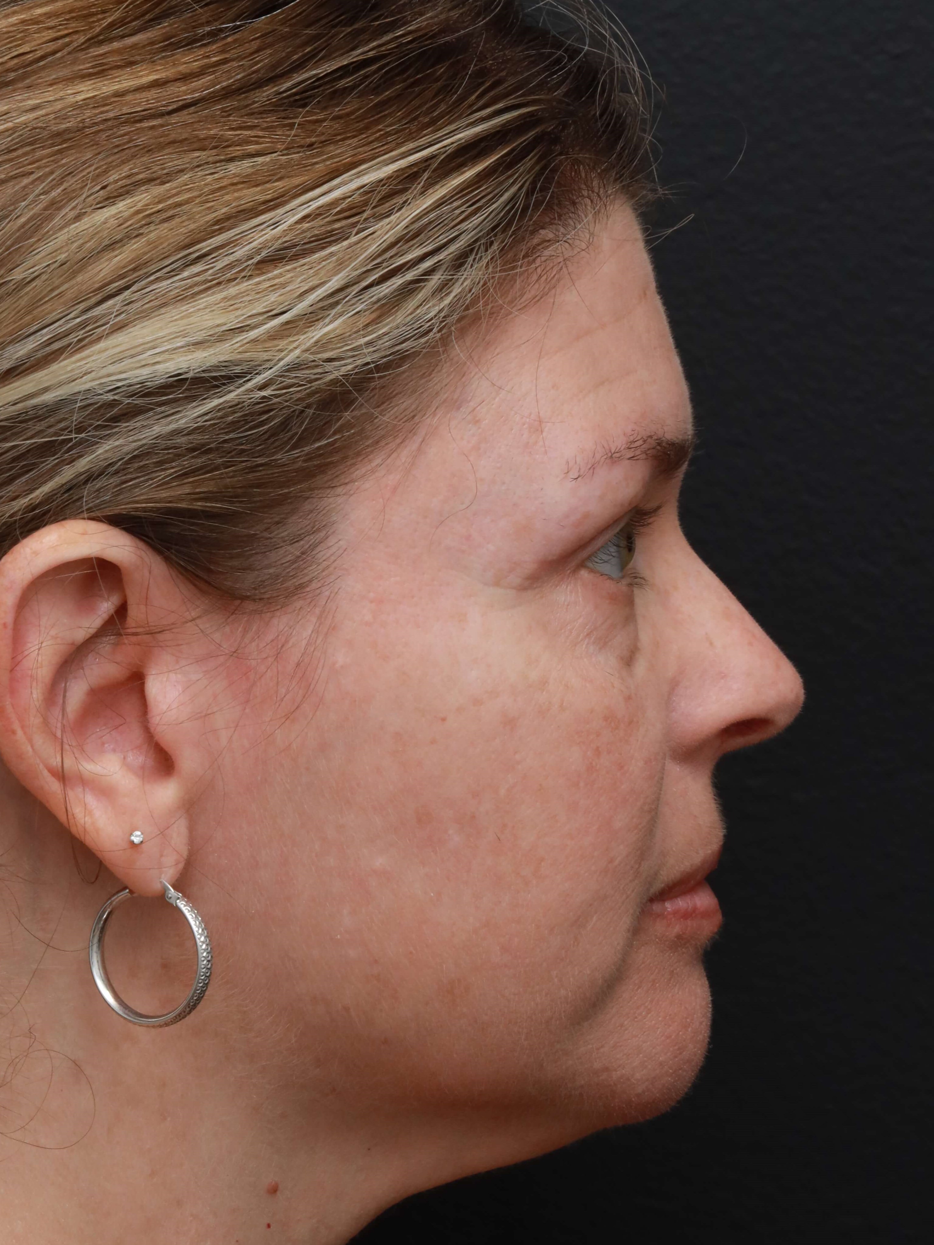 Right Lateral After