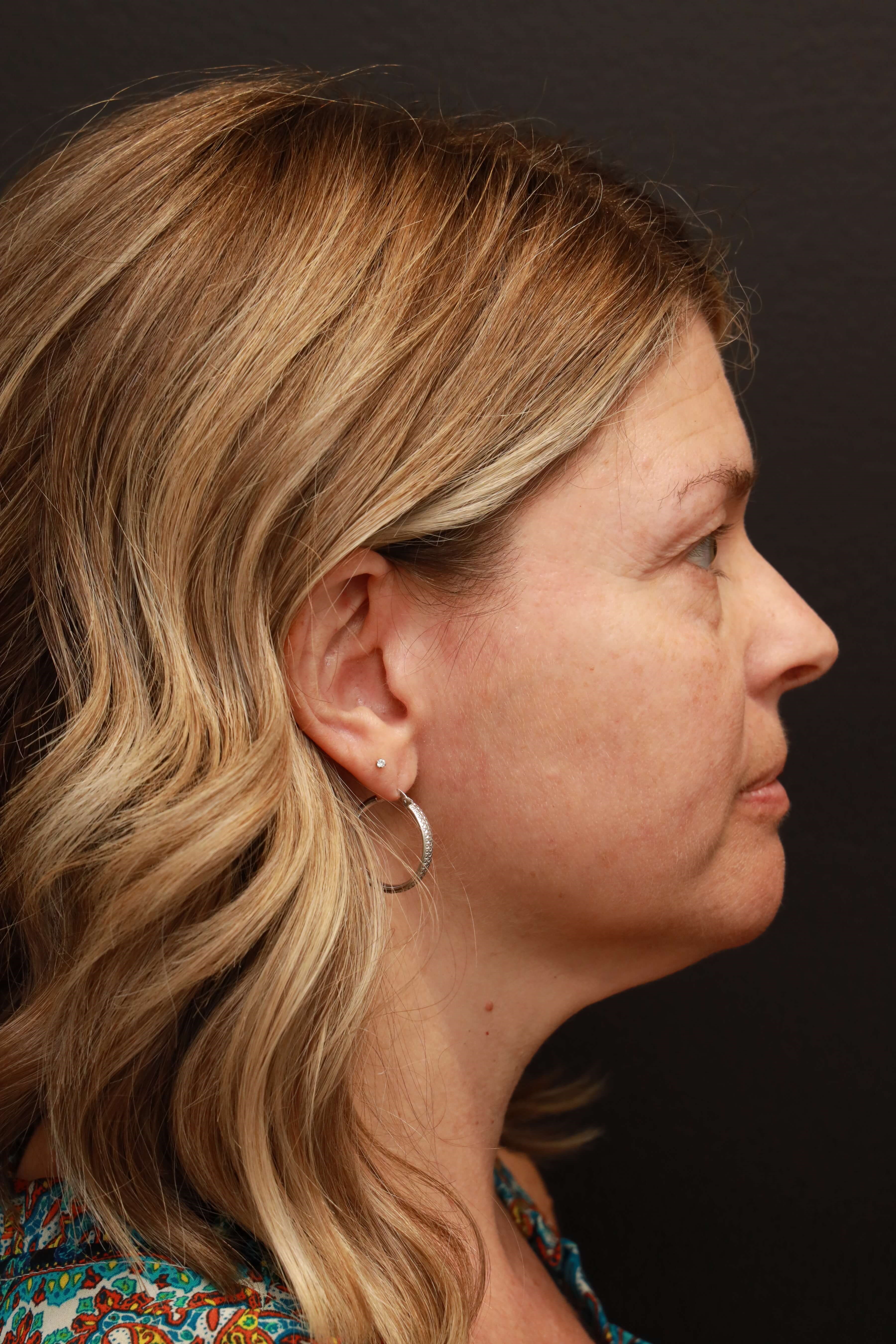 Right Lateral Before