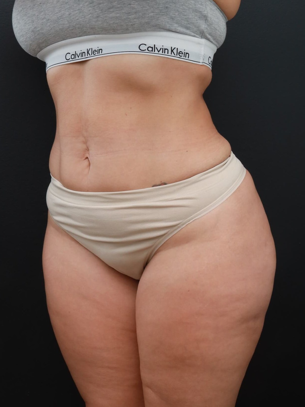 Left Oblique After