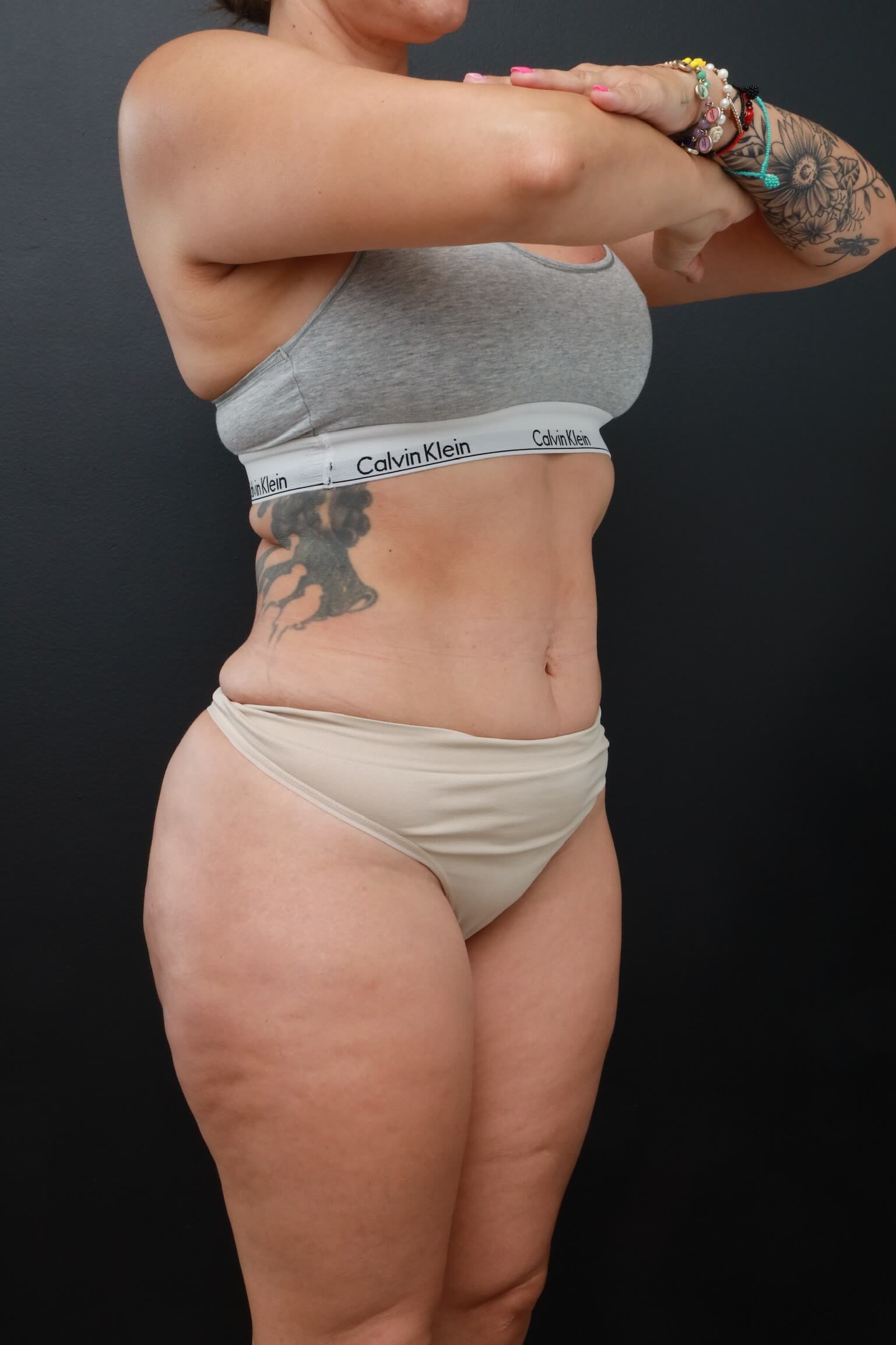 Right Oblique After