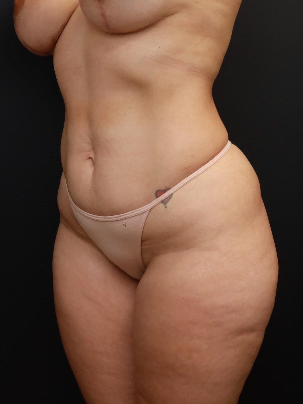 Left Oblique Before